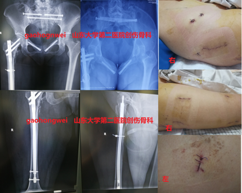 创伤骨科向齐河县人民医院推广机器人技术(1)609.png