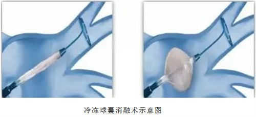 心内房颤1_副本
