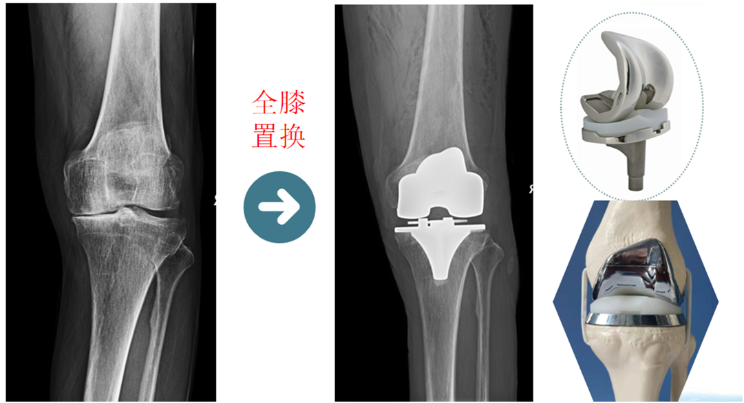 膝关节单髁置换术费用图片